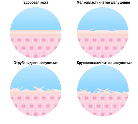 Пырышки - небольшие выпуклости на поверхности кожи