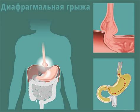 Разблокировка диафрагмы: основные причины и способы восстановления