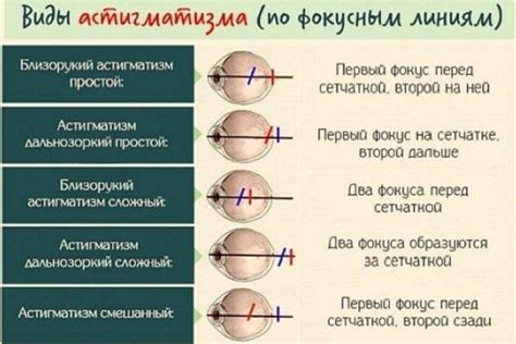 Развитие смешанного астигматизма у детей