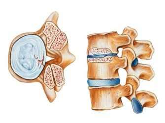 Различные методы лечения протрузии межпозвоночных дисков