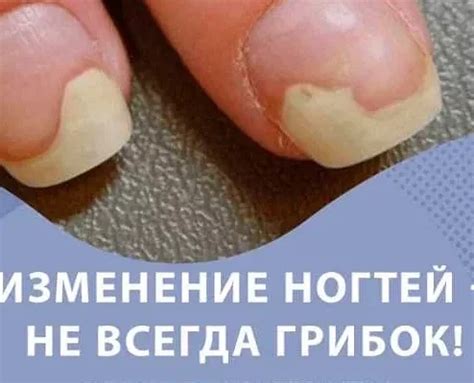 Различные методы лечения системного микоза