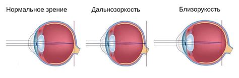 Различные методы лечения цилиндра глаза