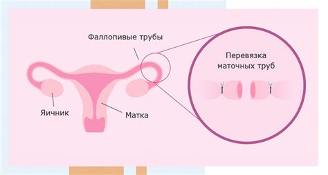 Различные методы стерилизации у женщин