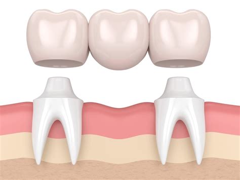 Различные типы мостов для зубов