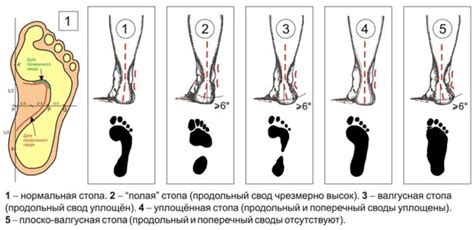 Разновидности нормальной стопы и их особенности