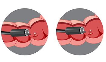 Разновидности эндоскопической полипэктомии