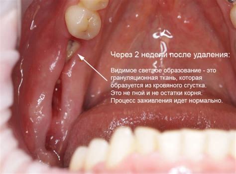 Разнообразные интерпретации вырывания зуба в сновидении