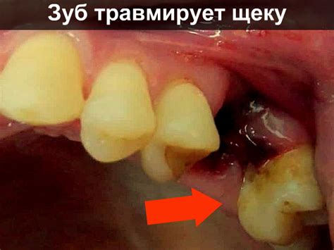 Разряженный зуб: причины и последствия