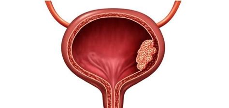 Рак мочевого пузыря: симптомы и методы диагностики