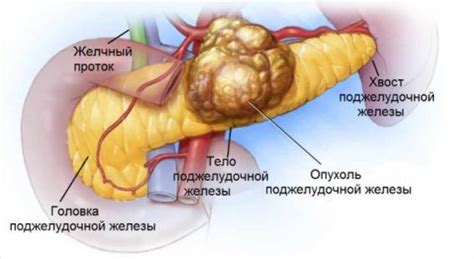 Рак поджелудочной 4 стадии: описание и характеристики