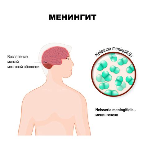 Ранняя диагностика менингита: симптомы и признаки