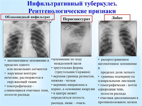 Распад легких при туберкулезе