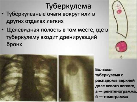 Распад туберкуломы: причины, симптомы и лечение