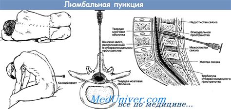 Распространенные причины головной боли после пункции спинного мозга