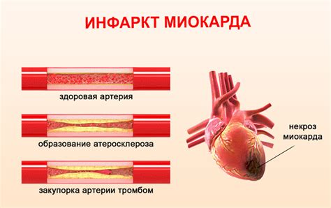 Распространенные причины появления миокарда 15 процентов