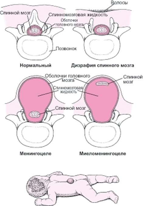 Расстройства развития нервной трубки и их последствия