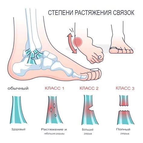 Растяжение связок: причины, симптомы и лечение