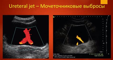 Расширение чашечек при УЗИ почек