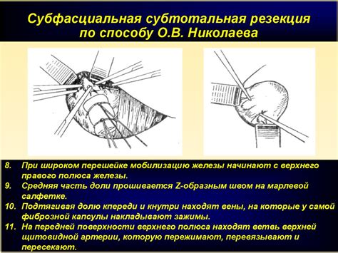 Расширенное удаление опухоли: субтотальная резекция