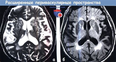Расширенные мелкие периваскулярные пространства