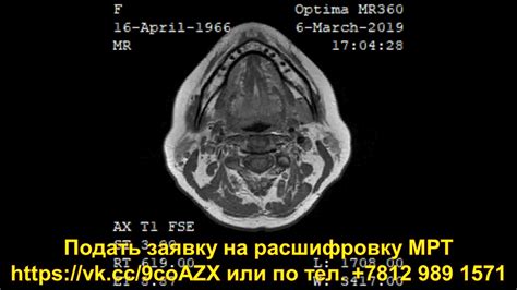 Расшифровка результатов УЗИ мягких тканей шеи: основные показатели и интерпретация