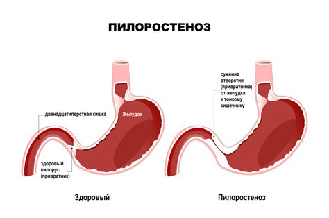 Рвота кислая: причины и лечение