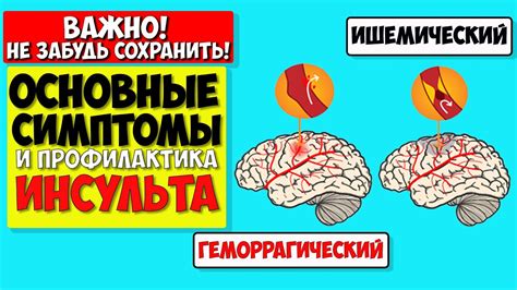 Реабилитационный период после геморрагического инсульта: что нужно знать