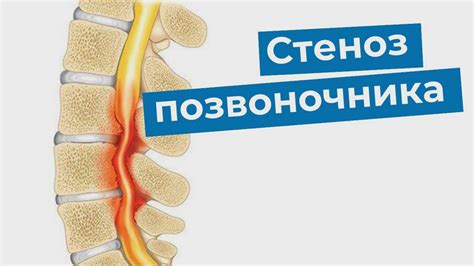 Реабилитация после лечения анатомической узости позвоночного канала