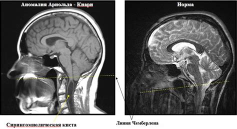 Реабилитация после лечения аномалии Арнольда-Киари 1 степени