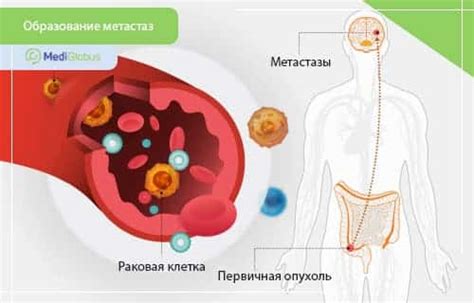 Реабилитация после лечения метастазов без первичного очага