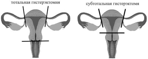 Регрессия миомы