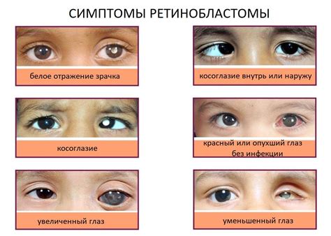 Редуцированные глаза у детей