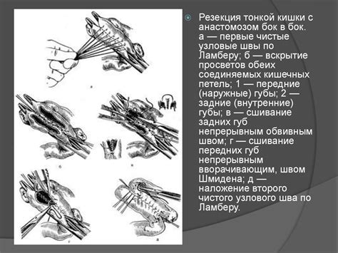 Резекция кишечника: основные аспекты процедуры