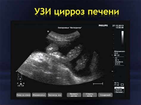 Результаты УЗИ при увеличении печени