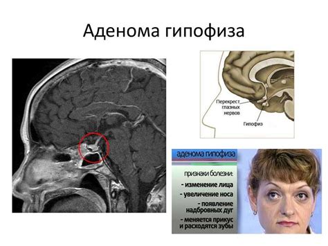 Результаты и побочные эффекты лечения микроаденомы гипофиза