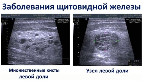 Результаты и толкование УЗИ шитовидной железы