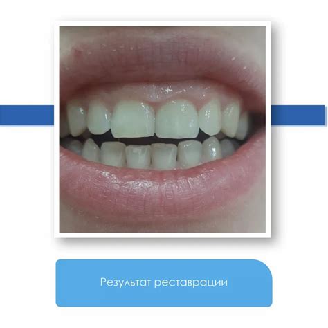 Результаты пролечки канала зуба