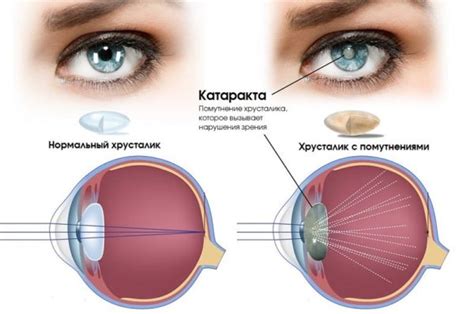 Результаты удаления катаракты