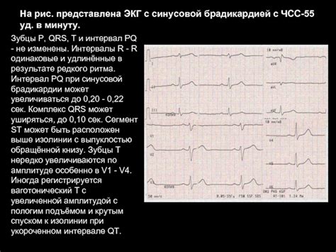 Рекомендации для пациентов с синусовой брадикардией в вертикальном положении