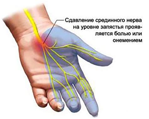 Рекомендации при болях в суставах на руках