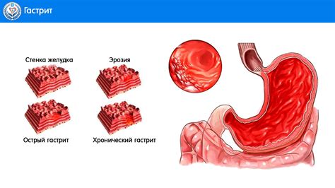 Ремиссия хронического гастрита: причины, симптомы и методы лечения