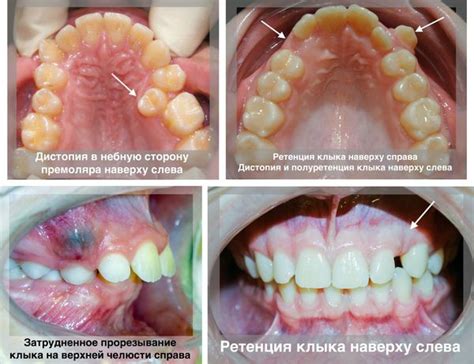 Ретенция зубов: влияющие факторы и следствия