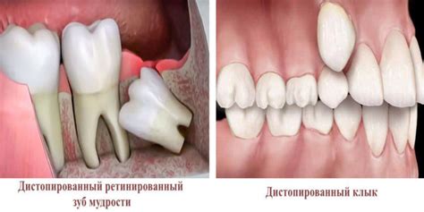 Ретинированный дистопированный зуб