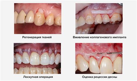 Рецессия десны: признаки, причины, осложнения