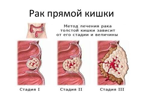 Риски и осложнения при тубулярной аденоме прямой кишки