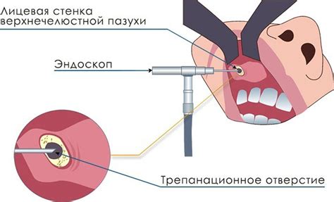 Риски снижения пневматизации гайморовой пазухи