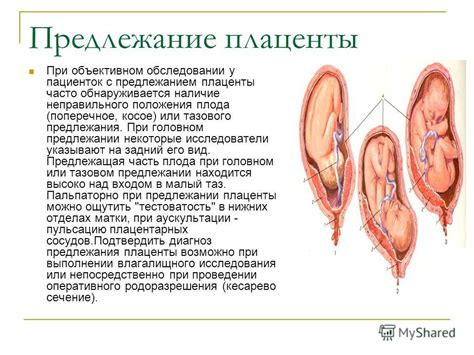 Риск возникновения тазового предлежания плаценты