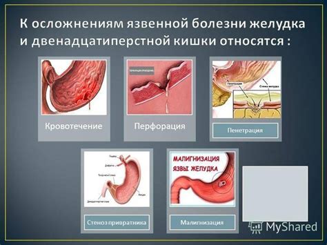 Риск кровотечения из желудка