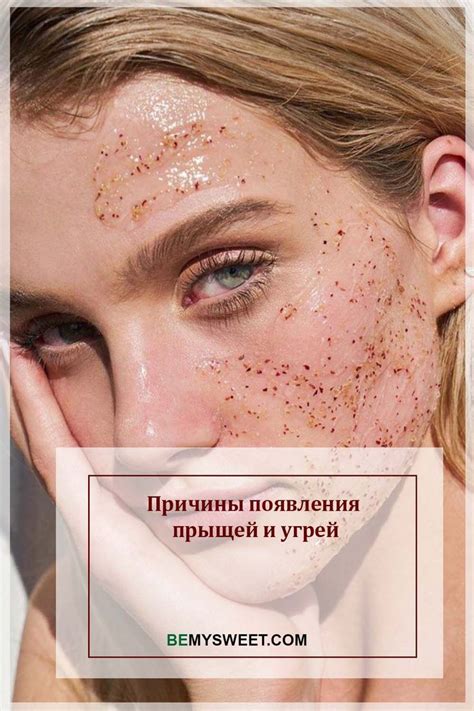 Риск появления угрей и прыщей