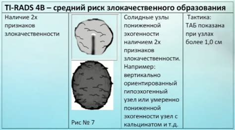 Риск развития злокачественного образования